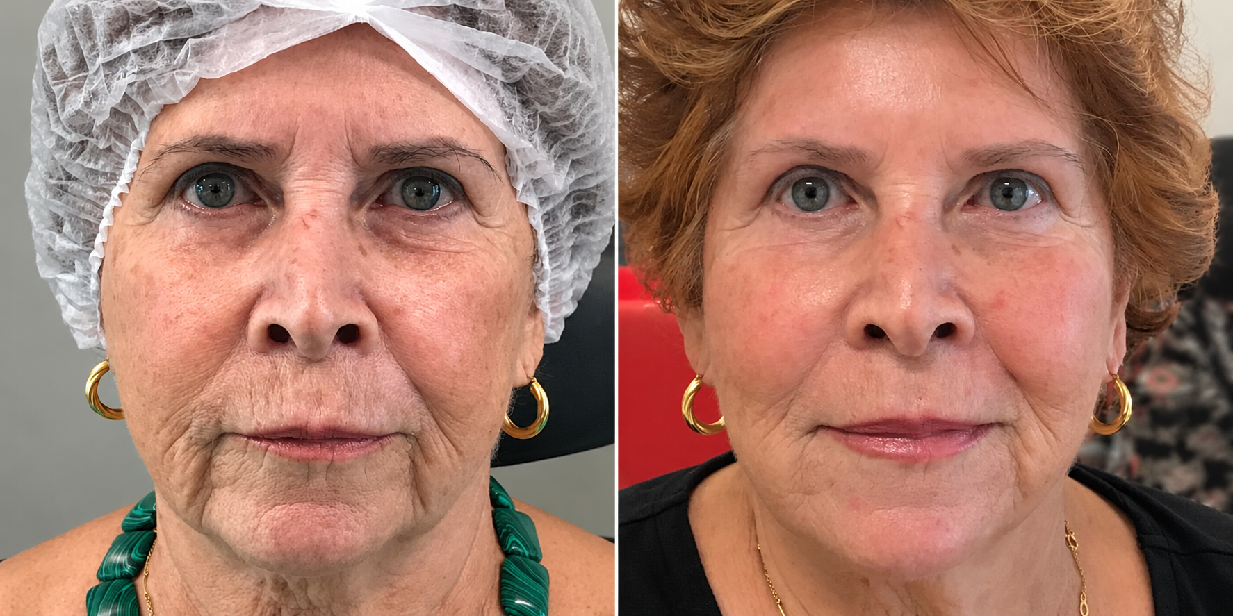 Fotografia de antes e depois 5, material fornecido pela New Face